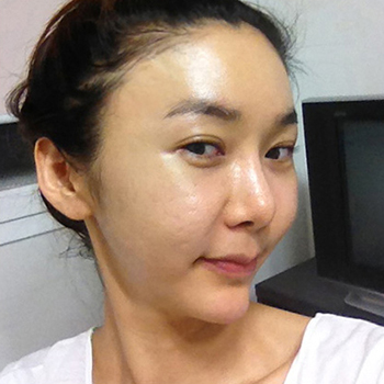 周口華美整形醫(yī)院翟紅光醫(yī)生做面部除皺效果怎么樣？附案例效果對比圖