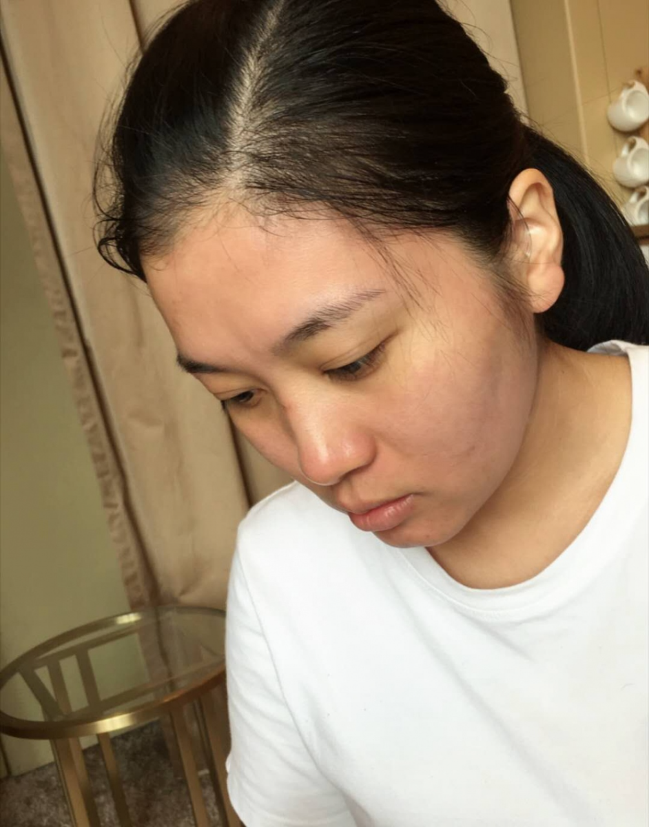 哈爾濱禾力康整形醫(yī)院劉亞春醫(yī)生做點(diǎn)陣激光去痘印效果怎么樣？附案例