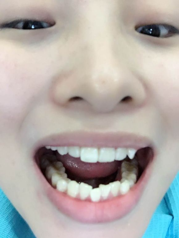 重慶齊美口腔周映丞醫(yī)生做牙齒隱形矯正怎么樣？附牙齒隱形矯正案例