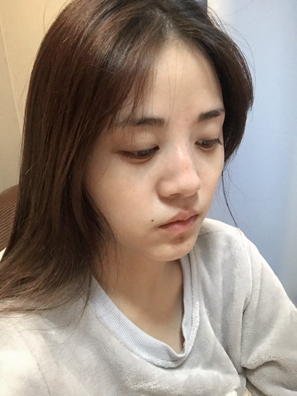 駐馬店締萊美醫(yī)療整形醫(yī)生李冰做鼻綜合整形怎么樣？附鼻綜合整形案例效果對(duì)比圖