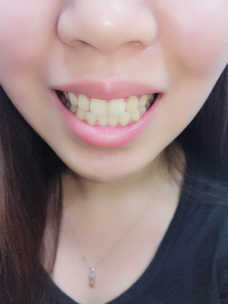 杭州國雅口腔醫(yī)院張虹醫(yī)生做冷光美白效果怎么樣？附冷光美白案例效果對比圖