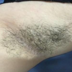 廈門(mén)張銘整醫(yī)療整形醫(yī)生張小玲做激光脫腋毛怎么樣？附激光脫腋毛效果對(duì)比圖