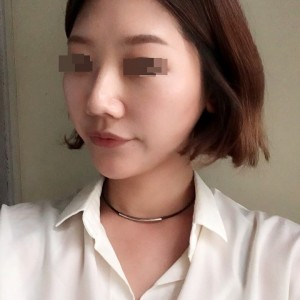 太原麗都整形醫(yī)院劉晉艷醫(yī)生做光纖溶脂瘦臉怎么樣？附案例效果對(duì)比圖
