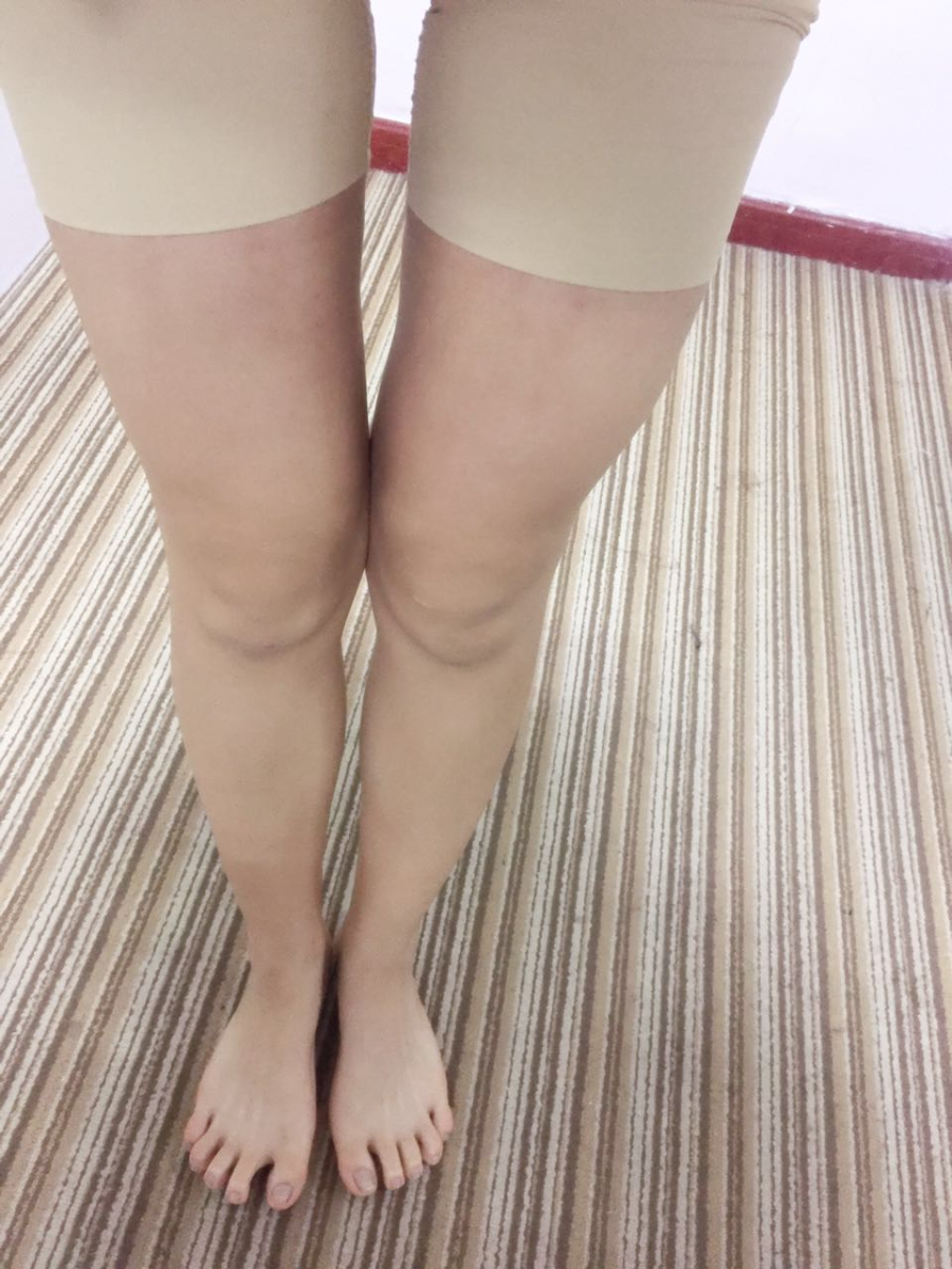 北京蒂凡妮整形靳玉彪醫(yī)生做大腿吸脂怎么樣？附大腿吸脂案例效果對(duì)比圖