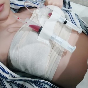 廣州廣大整形美容醫(yī)院醫(yī)生查旭山做假體隆胸怎么樣？附案例