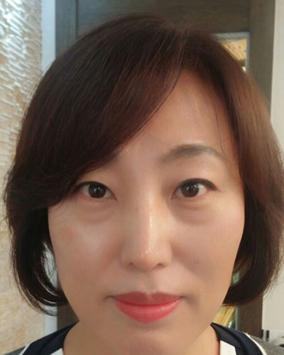 北京四季美學炫美整形醫(yī)生高玲做埋線祛眼袋怎么樣？附案例效果對比圖
