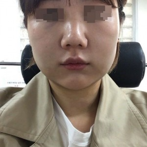 太原麗都整形醫(yī)院劉晉艷醫(yī)生做光纖溶脂瘦臉怎么樣？附案例效果對(duì)比圖