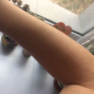 鄭州屈小麗醫(yī)療整形醫(yī)院醫(yī)生劉丹做手臂脫毛怎么樣？附手臂脫毛案例