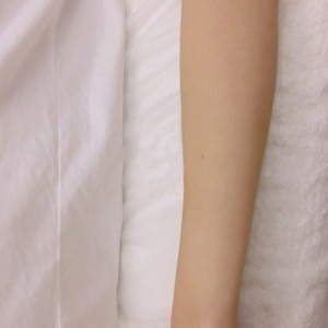 鄭州屈小麗醫(yī)療整形醫(yī)院醫(yī)生劉丹做手臂脫毛怎么樣？附手臂脫毛案例