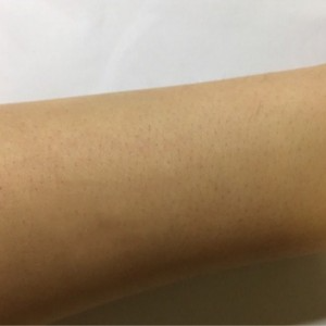 鄭州屈小麗醫(yī)療整形醫(yī)院醫(yī)生劉丹做手臂脫毛怎么樣？附手臂脫毛案例