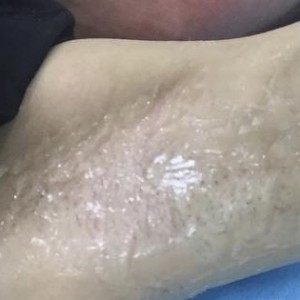 廈門張銘整醫(yī)療整形醫(yī)生張小玲做激光脫腋毛怎么樣？附激光脫腋毛效果對(duì)比圖