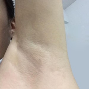廈門張銘整醫(yī)療整形醫(yī)生張小玲做激光脫腋毛怎么樣？附激光脫腋毛效果對(duì)比圖