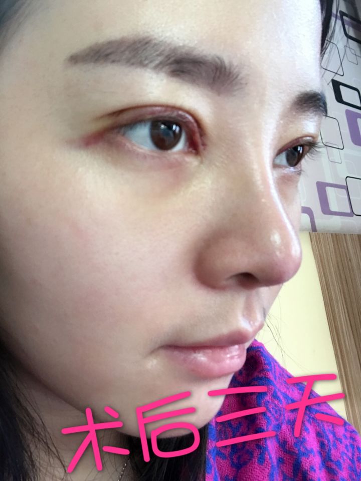 北京京韓整形醫(yī)生王義山做埋線雙眼皮怎么樣？附案例效果對比圖