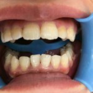 洛陽友好口腔醫(yī)院醫(yī)生楊愛芳做牙齒冷光美白怎么樣？附案例效果圖