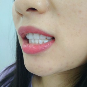 洛陽友好口腔醫(yī)院醫(yī)生李新然做牙貼面怎么樣？附案例效果圖