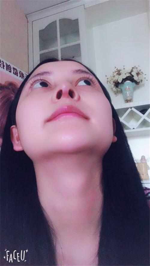 鄭州華領醫(yī)療美容醫(yī)院醫(yī)生張永濤做硅膠假體隆鼻怎么樣？附案例效果對比圖