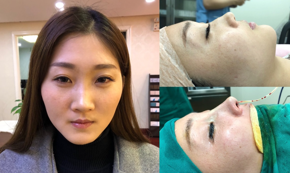上海首爾麗格醫(yī)療美容醫(yī)院醫(yī)生樸晟秀做膨體隆鼻怎么樣？附案例效果圖