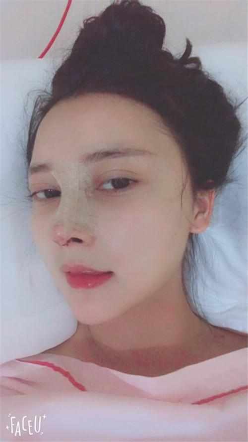 鄭州華領醫(yī)療美容醫(yī)院醫(yī)生張永濤做硅膠假體隆鼻怎么樣？附案例效果對比圖