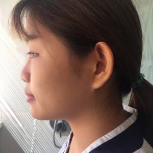 北京京民醫(yī)院整形外科醫(yī)生李鴻儒做硅膠隆鼻怎么樣？附案例效果圖