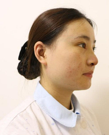 深圳陽(yáng)光整形美容醫(yī)院醫(yī)生張平做膨體隆鼻+雙眼皮+注射瘦臉案例效果對(duì)比圖