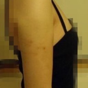 岳陽愛思特醫(yī)療美容醫(yī)院醫(yī)生王福生做手臂吸脂怎么樣？附案例效果圖