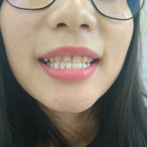 洛陽友好口腔醫(yī)院醫(yī)生李新然做牙貼面怎么樣？附案例效果圖