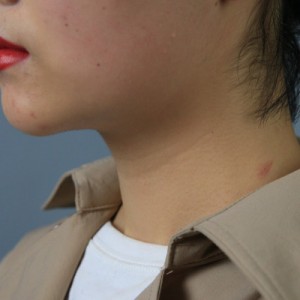 上海名媛醫(yī)療整形醫(yī)生閆嬌君做嗨體去頸紋效果怎么樣？附案例效果圖