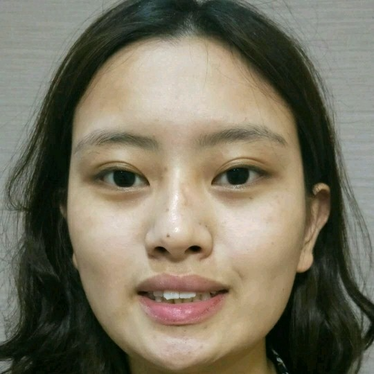 廣州愛來整形醫(yī)院醫(yī)生肖大衛(wèi)做激光點痣怎么樣？附案例效果對比圖