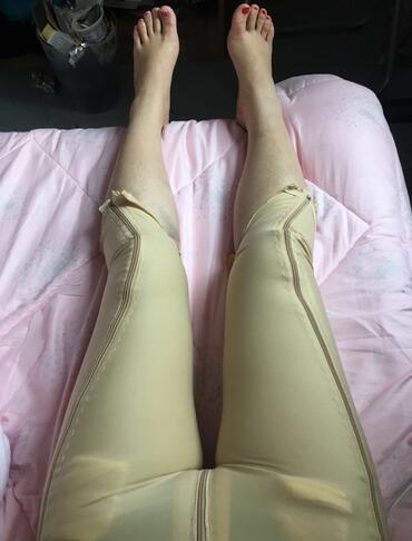 上海保加醫(yī)療美容門診部做大腿吸脂怎么樣？附楊勇醫(yī)生案例效果對比圖