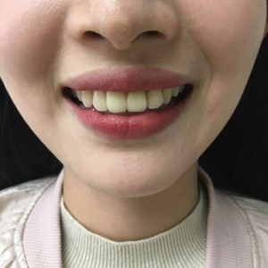 上海科瓦口腔醫(yī)院醫(yī)生鄧建儒做牙齒冷光美白怎么樣？附案例效果對(duì)比圖