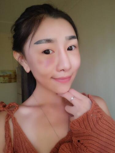 貴陽泰康樂醫(yī)院整形美容科醫(yī)生陳璐做自體脂肪全臉填充效果怎么樣？