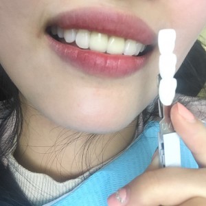 上海科瓦口腔醫(yī)院醫(yī)生鄧建儒做牙齒冷光美白怎么樣？附案例效果對比圖