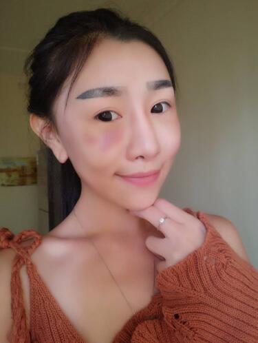 貴陽泰康樂醫(yī)院整形美容科醫(yī)生陳璐做自體脂肪全臉填充效果怎么樣？