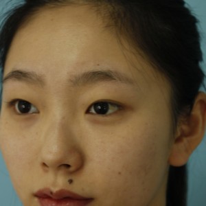 鄭州安格潤整形醫(yī)生楊曉紅做雙眼皮手術(shù)怎么樣？附案例效果圖