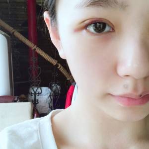 鄭州安格潤整形醫(yī)生楊曉紅做雙眼皮手術(shù)怎么樣？附案例效果圖