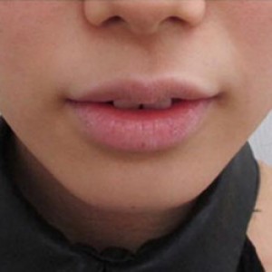 蚌埠韓美美萊整形醫(yī)院醫(yī)生張濤做玻尿酸墊下巴怎么樣？來看案例效果圖