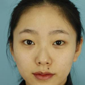 鄭州安格潤(rùn)整形醫(yī)生楊曉紅做雙眼皮手術(shù)怎么樣？附案例效果圖