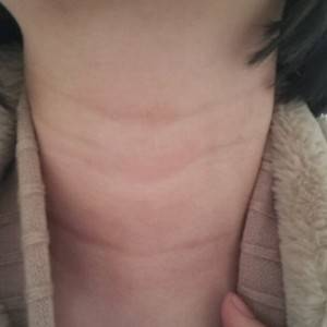 昭通愛麗諾整形醫(yī)生陳志江做嗨體去頸紋怎么樣？附案例效果圖