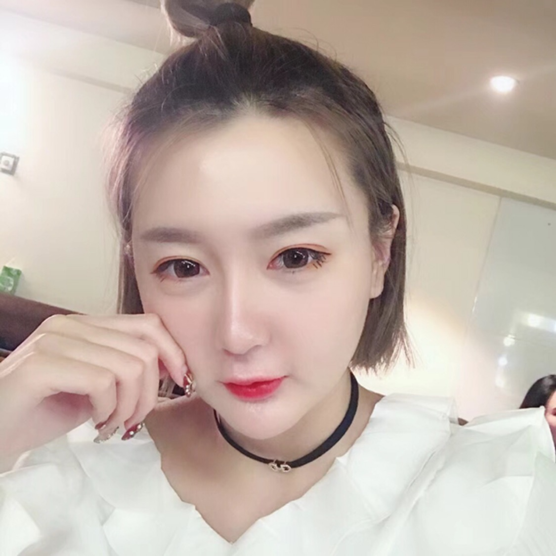 杭州格萊美整形美容醫(yī)院醫(yī)生張霞飛做自體脂肪全臉填充效果怎么樣？
