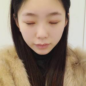 鄭州安格潤整形醫(yī)生楊曉紅做雙眼皮手術(shù)怎么樣？附案例效果圖