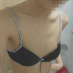 三亞圣迪亞整形美容醫(yī)院醫(yī)生韓超做假體隆胸怎么樣？附案例效果對比圖