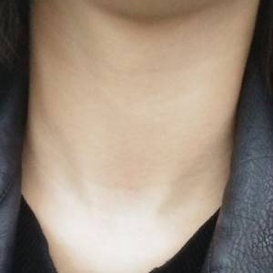 昭通愛麗諾整形醫(yī)生陳志江做嗨體去頸紋怎么樣？附案例效果圖