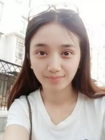 長治松禾醫(yī)療美容診所醫(yī)生馬俊峰做韓式微創(chuàng)定點雙眼皮效果怎么樣？附案例