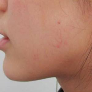 蚌埠韓美美萊整形醫(yī)院醫(yī)生張濤做玻尿酸墊下巴怎么樣？來(lái)看案例效果圖