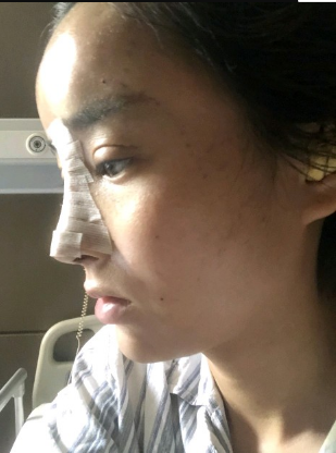 武漢米蘭醫(yī)療美容醫(yī)生柳再億做眼綜合+鼻綜合整形怎么樣？附真實(shí)案例對(duì)比圖