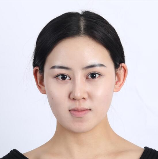 上海時光整形外科醫(yī)院醫(yī)生李靜林做假體隆鼻和反頜手術(shù)怎么樣？