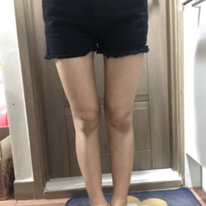 貴陽華美整形美容醫(yī)院醫(yī)生田永華做大腿吸脂效果怎么樣？附大腿吸脂案例前后對比圖