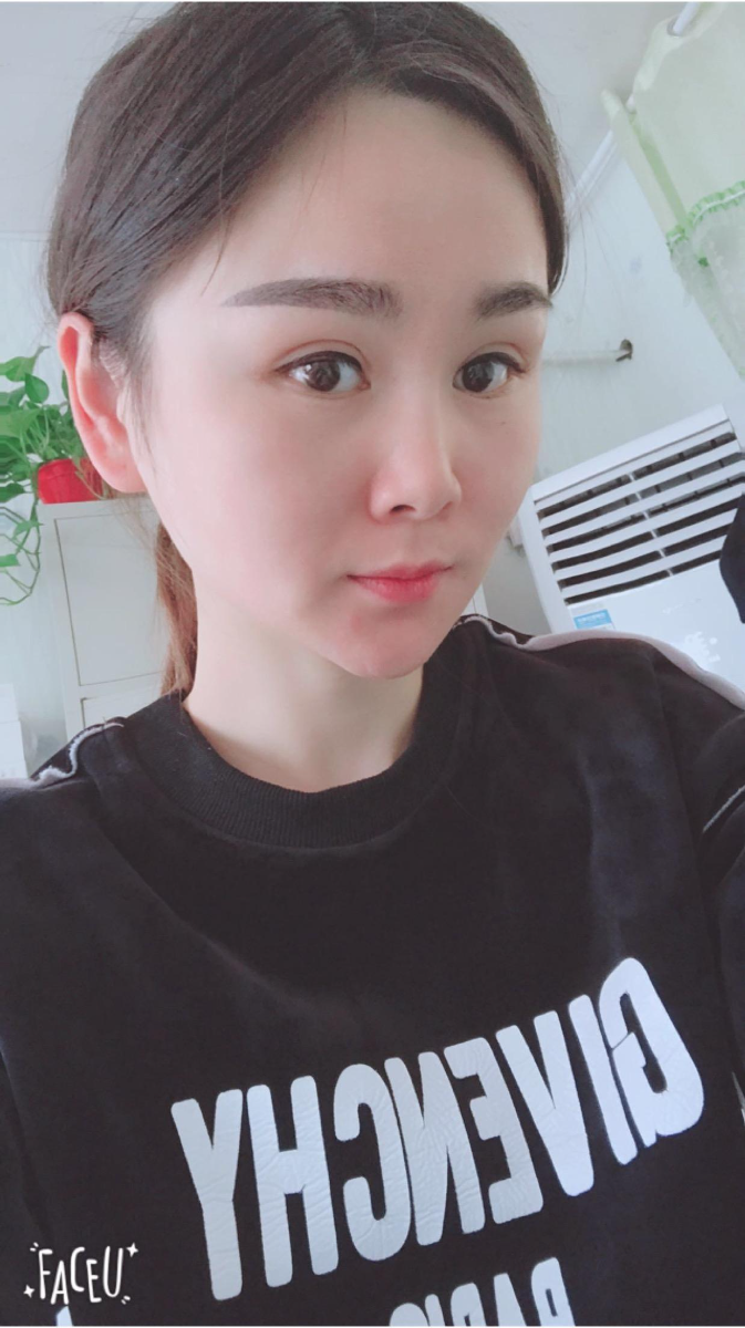 北京彤美美容整形醫(yī)院醫(yī)生楊曉惠做顴骨內(nèi)推+面部吸脂手術(shù)效果怎么樣？附案例