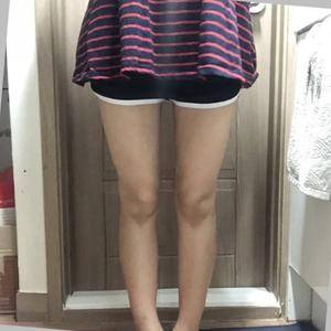 貴陽華美整形美容醫(yī)院醫(yī)生田永華做大腿吸脂效果怎么樣？附大腿吸脂案例前后對比圖