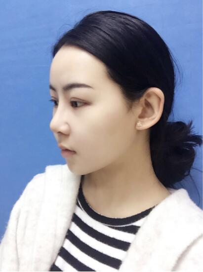 上海時光整形外科醫(yī)院醫(yī)生李靜林做假體隆鼻和反頜手術怎么樣？